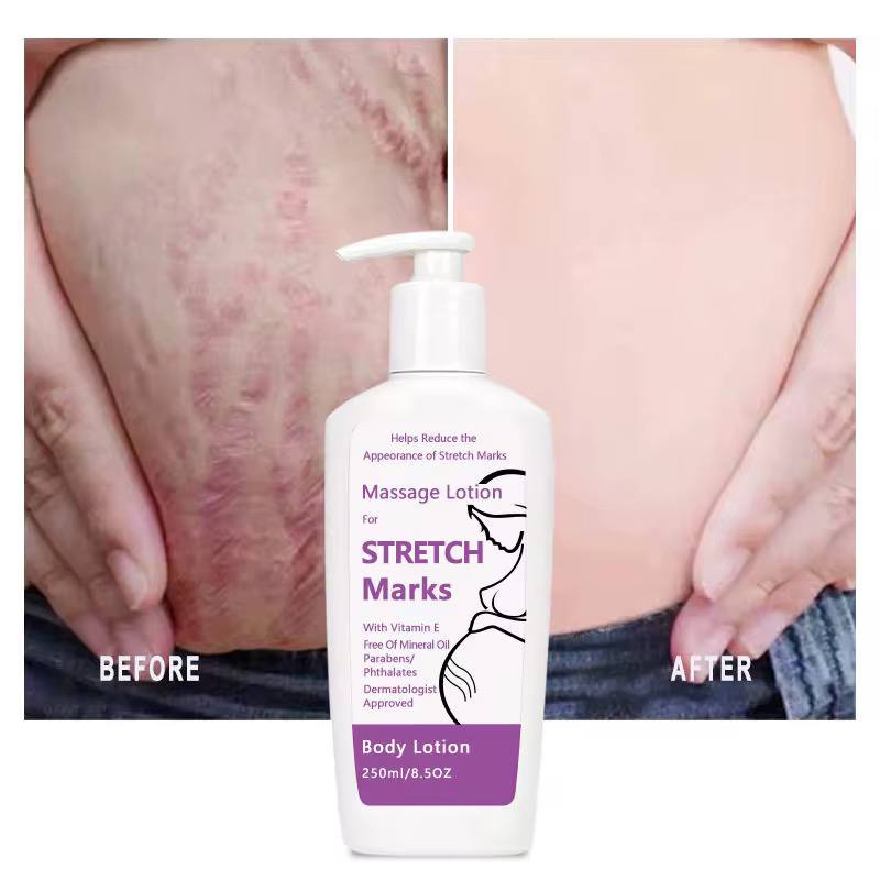 stretch mark repair kit